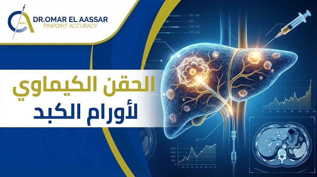 الحقن الكيماوي لاورام الكبد